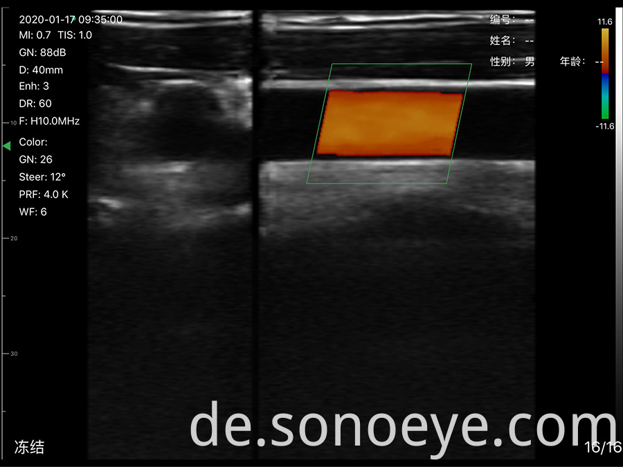 wirelss ultrasound